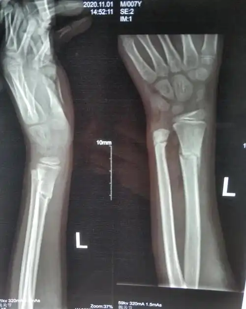 经过1个月的治疗后复查片可见骨折端对位对线良好,可见大量骨痂生长.