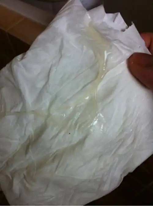 正常的白带应该是乳白色或无色透明,略带腥味或无味其分泌量质地受体