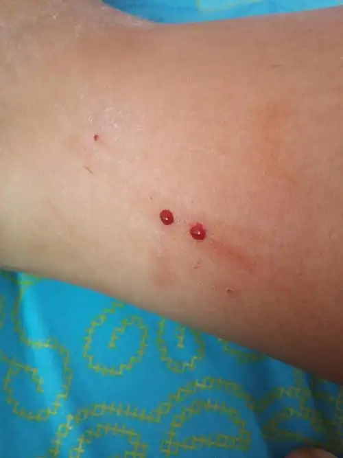 被蛇咬了怎么办