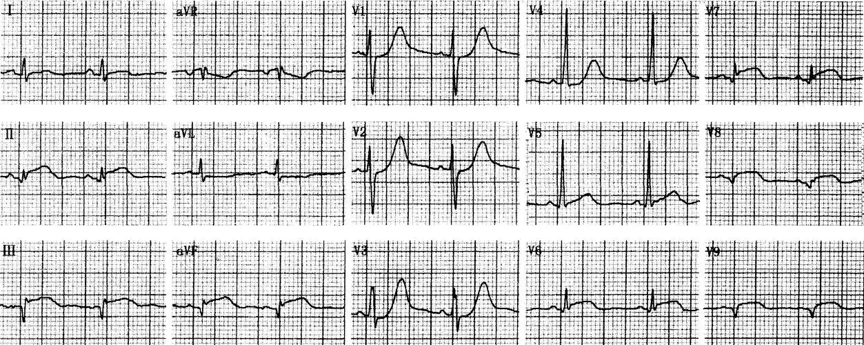 4 正后壁心肌梗死-心电图临床实习-医学