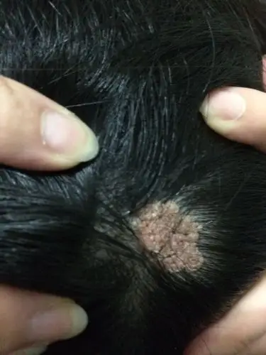 医生看看这是怎么了?在头上,是小时候以前