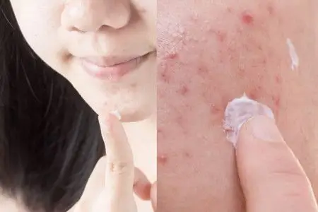 【图】脸上痘痘挤出螨虫图 怎样治疗更加有效