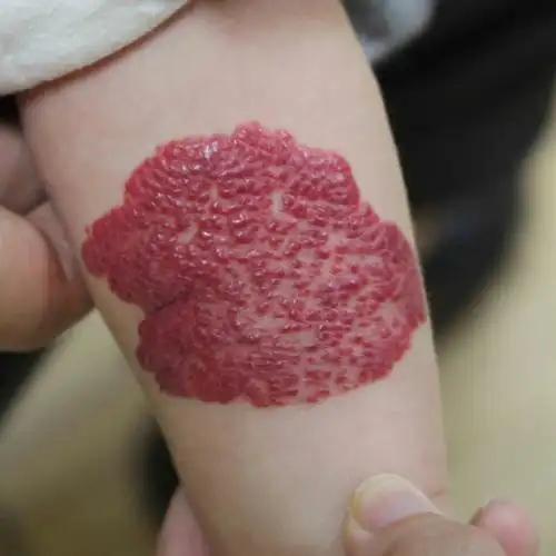 邓娟主任告诉您,腿部血管瘤也要留心! - 商丘邓娟皮肤科