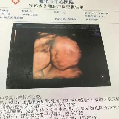 请帮忙看下四维彩超,是兔唇吗?很是担心!