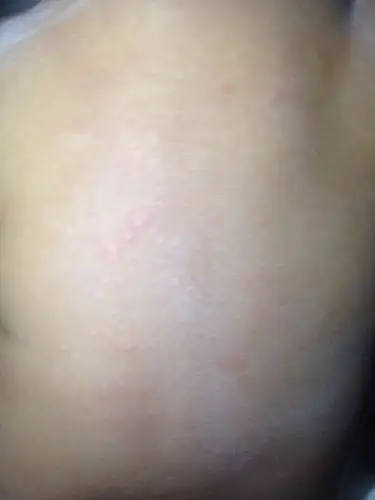 宝宝身上的白点是什么?