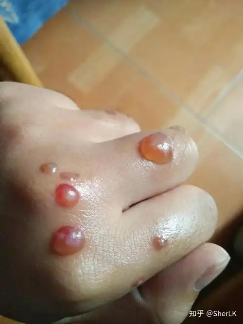 我的扁平疣治好啦