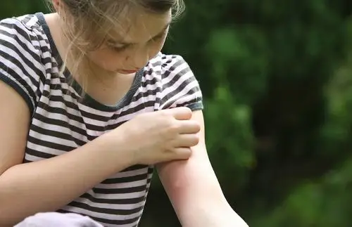 被蚊子咬后应如何快速止痒