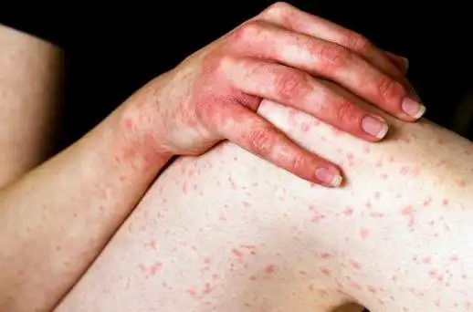 nhs: 不必太紧张|病毒|荨麻疹|花粉症|过敏症_网易订阅