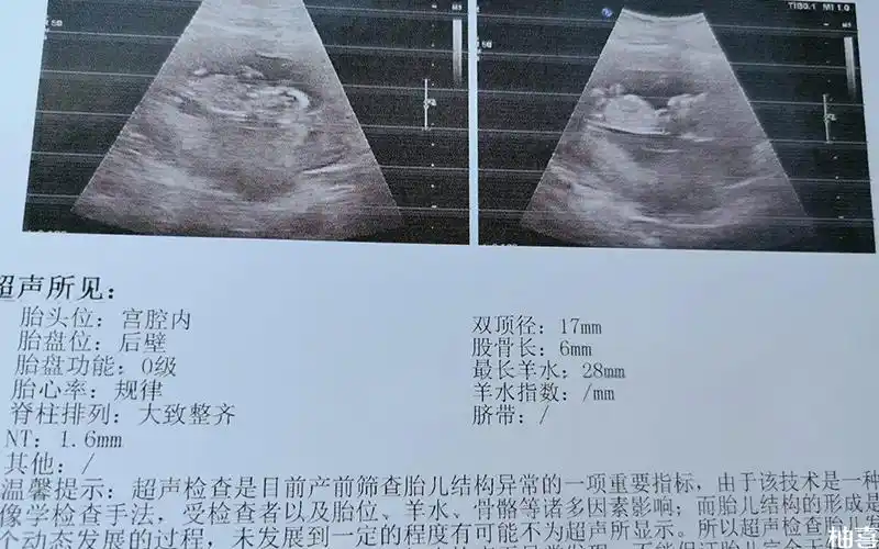 13周nt图脊柱弯着就是男孩,这种说法准吗?