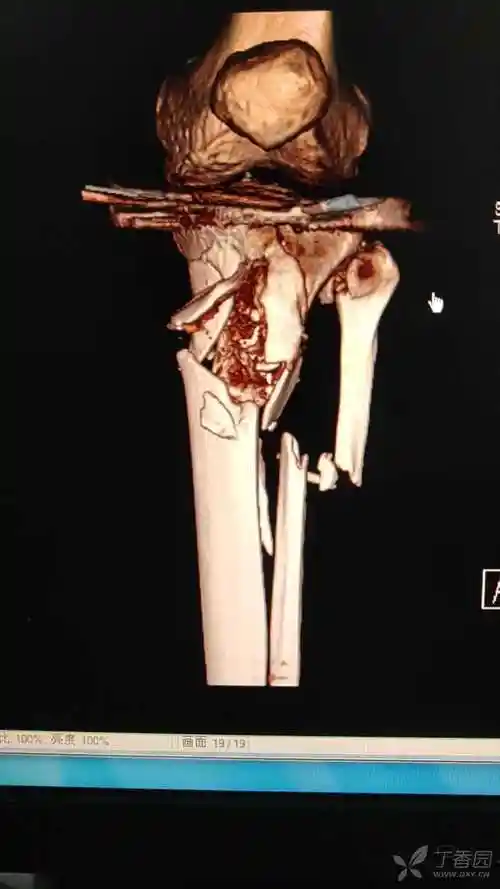 严重胫腓骨近端骨折1例