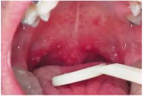 可出现在两颊部,硬腭,咽后壁,舌头,唇齿侧,偶尔还会出现在软腭,悬雍垂