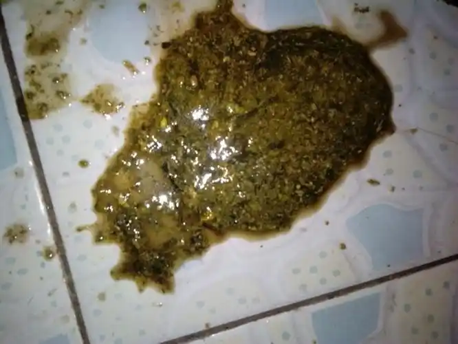 宝宝母乳性腹泻大便呈黑褐色图片