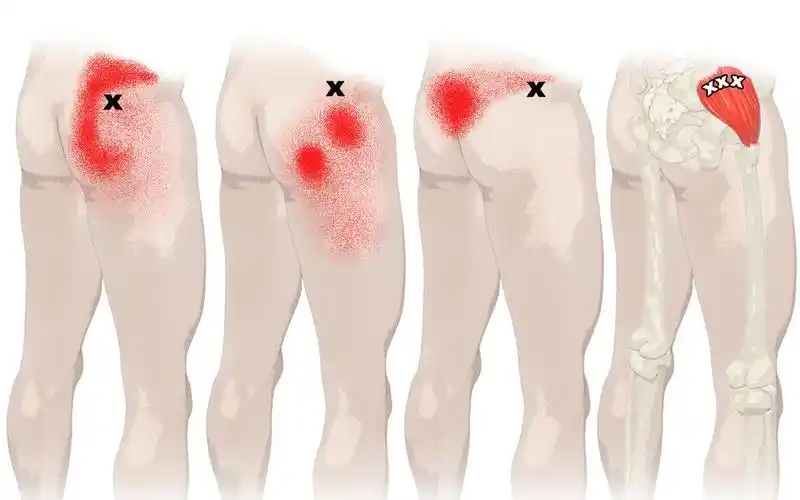 臀中肌 | 稳定骨盆的核心肌肉,也是调理腰膝疼痛不能忽略的肌肉!