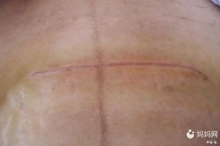 剖腹产二十七天,黑色素肚子上特别严重,伤口突出的像疤痕增生,恶露是
