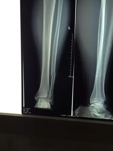 我是腓骨骨折,一个半月石膏拆了,为什么还是肿的,拆了快一周了,站起来