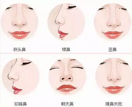 海南旅游预见美 -- 玻尿酸隆鼻,改善不完美鼻形