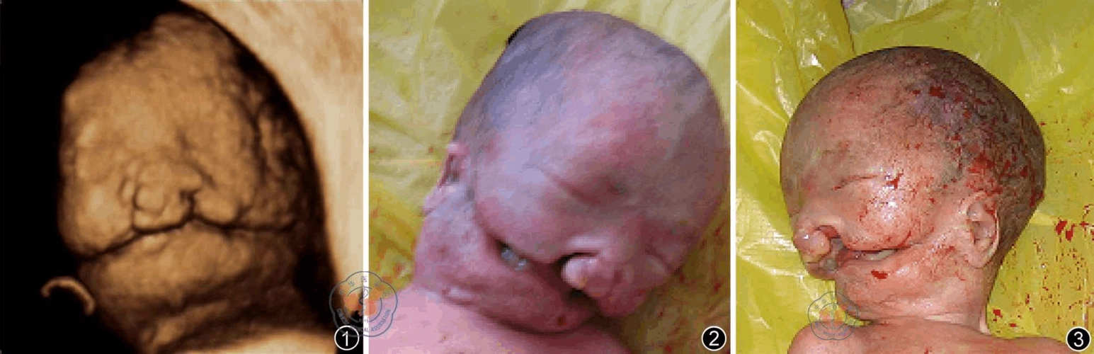 胎儿唇腭裂伴面横裂畸形产前超声表现一例