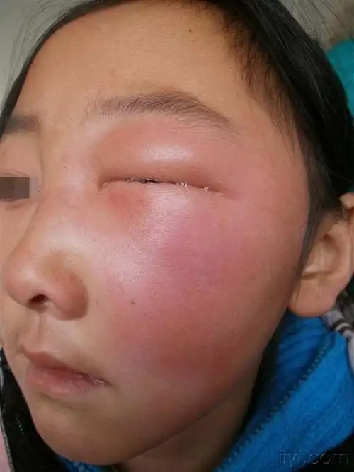 面部丹毒这个最好理解的,太冷引起的,主要发生在手足,面部和耳部这些