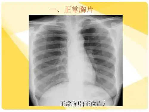 肺部疾病影像学阅片 一,正常胸片 正常胸片(正位片)