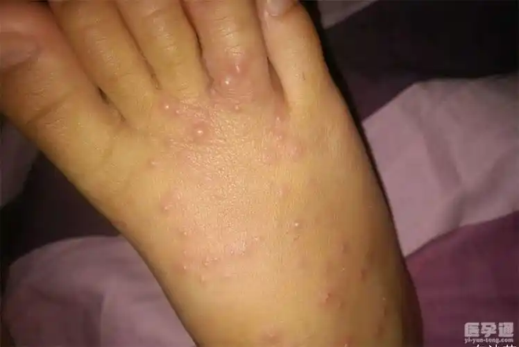 儿童出现水痘初期症状图片分享附正确护理方式