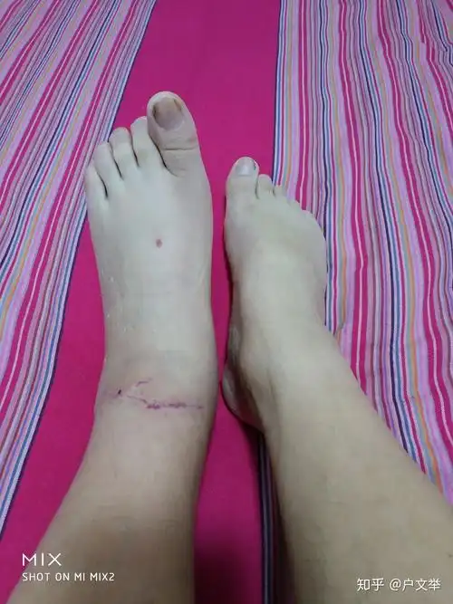 胫骨前肌腱断裂我的足下垂康复之路