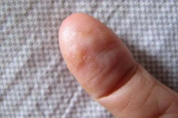 以洗手来说,能避免细菌与手部接触,但是,当你不经常洗手,则会造成细菌