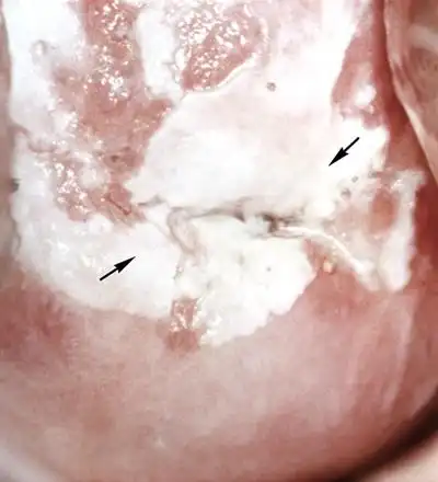 宫颈癌图片 (32)