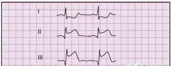 急诊宝典 | 5分钟快速掌握急性心梗的心电图判读