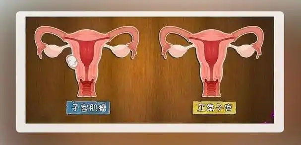 对女性的身体有很大的危害,子宫肌瘤大概率是由于这种不健康的生活方