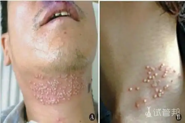 什么是单纯疱疹病毒