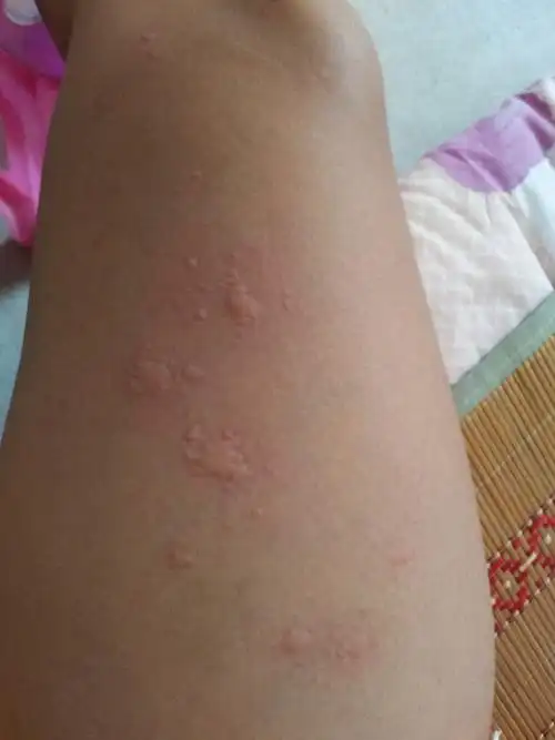 身上长了好多疱疹,只要上厨房做饭就有,平常在客厅都没事_皮肤科_邻医