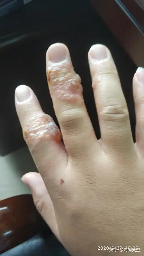 手指受伤贴了创口贴几个小时后贴创口贴的部位开始起水泡特别痒是过敏