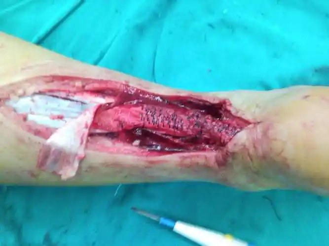 常见运动损伤 跟腱断裂 - 好大夫在线