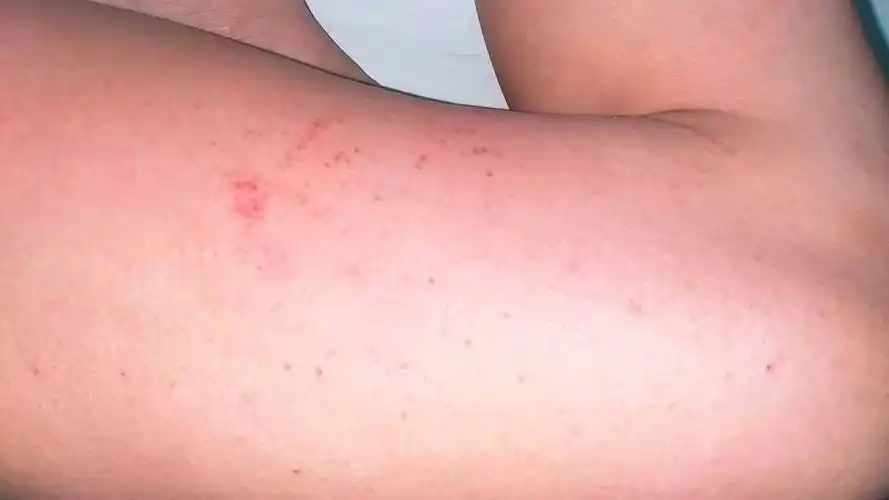 全身皮肤瘙痒,不抓没事,一抓就起疹子! 折到底是怎么回事,要怎样治疗?