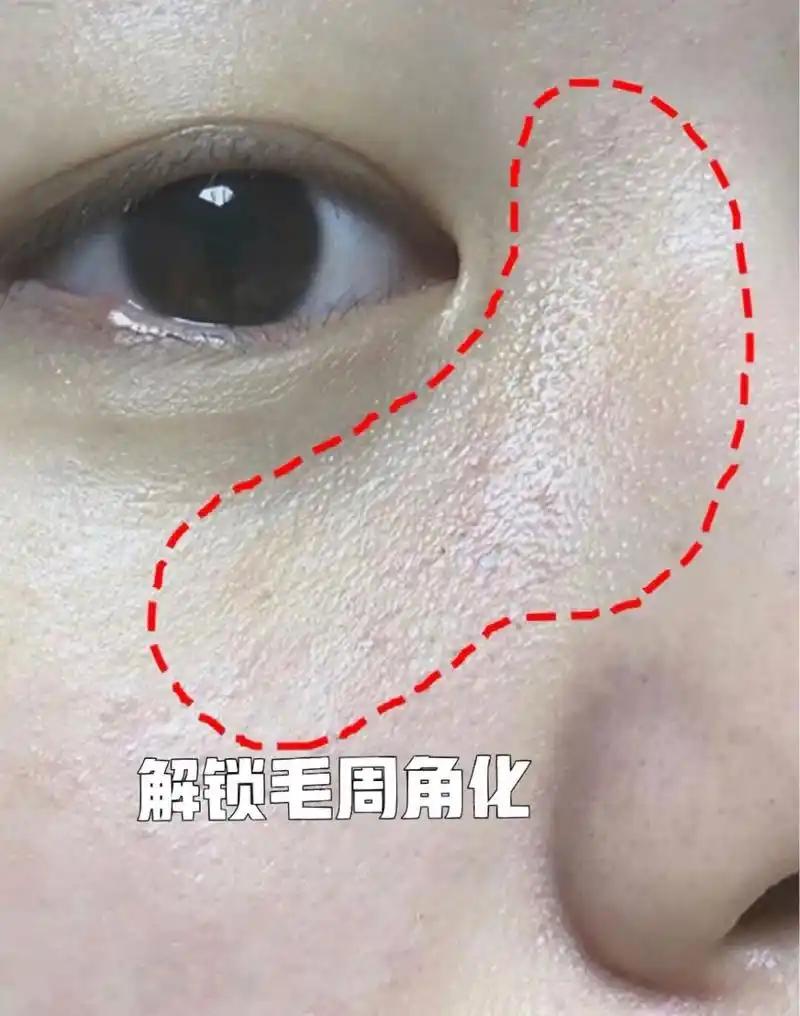 分辨毛周角化和脂肪粒 分清楚才可以更好的解决它