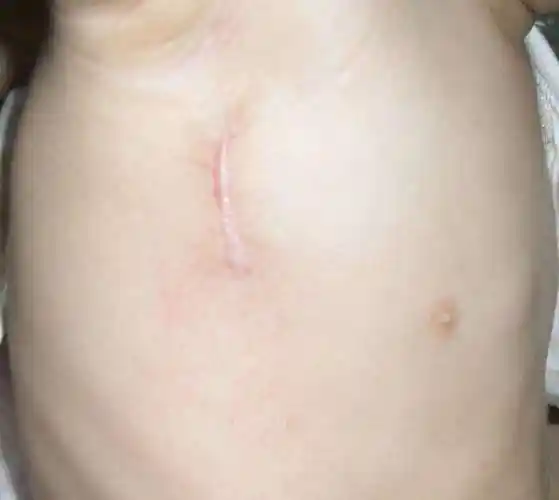 心脏手术的切口_先天性心脏病_先天性心脏病手术 - 好大夫在线