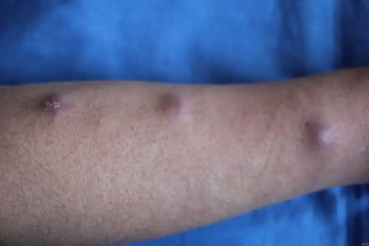 皮肤及性传播疾病讨论版 - 爱爱医医学论坛