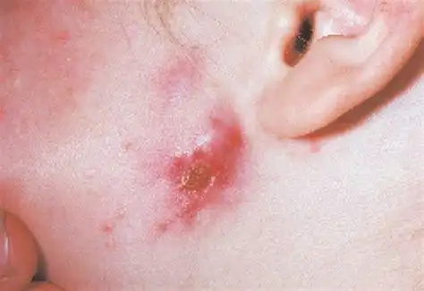 包括子宫内膜炎,输卵管炎,输卵管卵巢脓肿等,女性淋病初期症状表现为