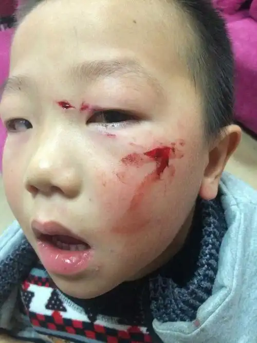 幼儿园同学推的,可是对方只赔医疗费!