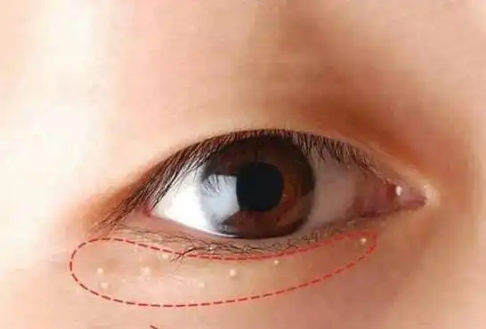 眼部脂肪粒如何消除呢?