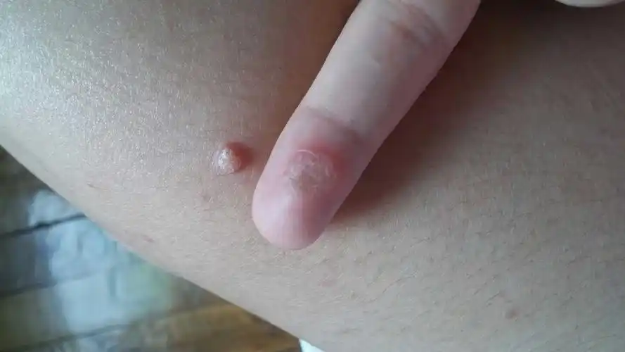 [武汉妈妈帮]怀孕四个月长了病毒疣