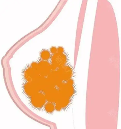 女子丰胸十年,胸跑后背【教你鉴别危害的整形材料】