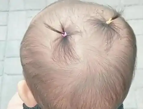 新生婴儿头发稀疏,几年后发量却"逆袭",是因为胎毛剃得早吗?