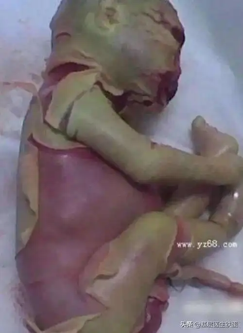 火棉胶样婴儿火棉胶婴儿长大后的图片是什么样的