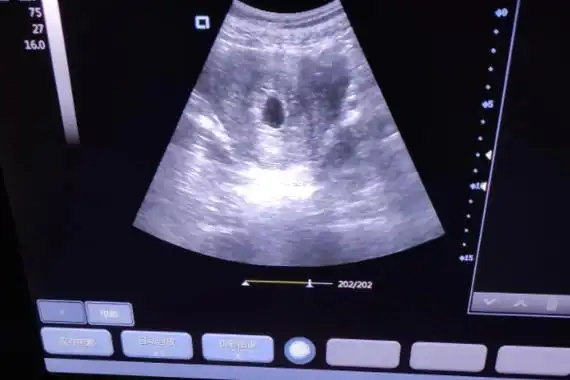 看孕囊的比值能看出孩子性别