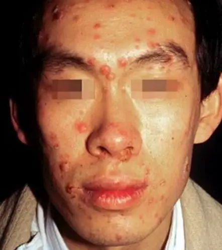 这样的表现就是常说的肝病面容图片