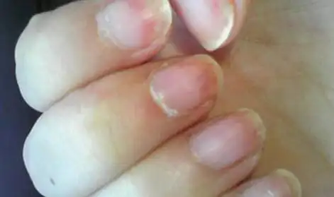 灰指甲是由真菌感染引起的.