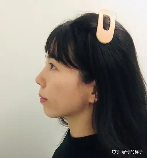 大龄女青年骨性嘴凸下巴后缩深覆合