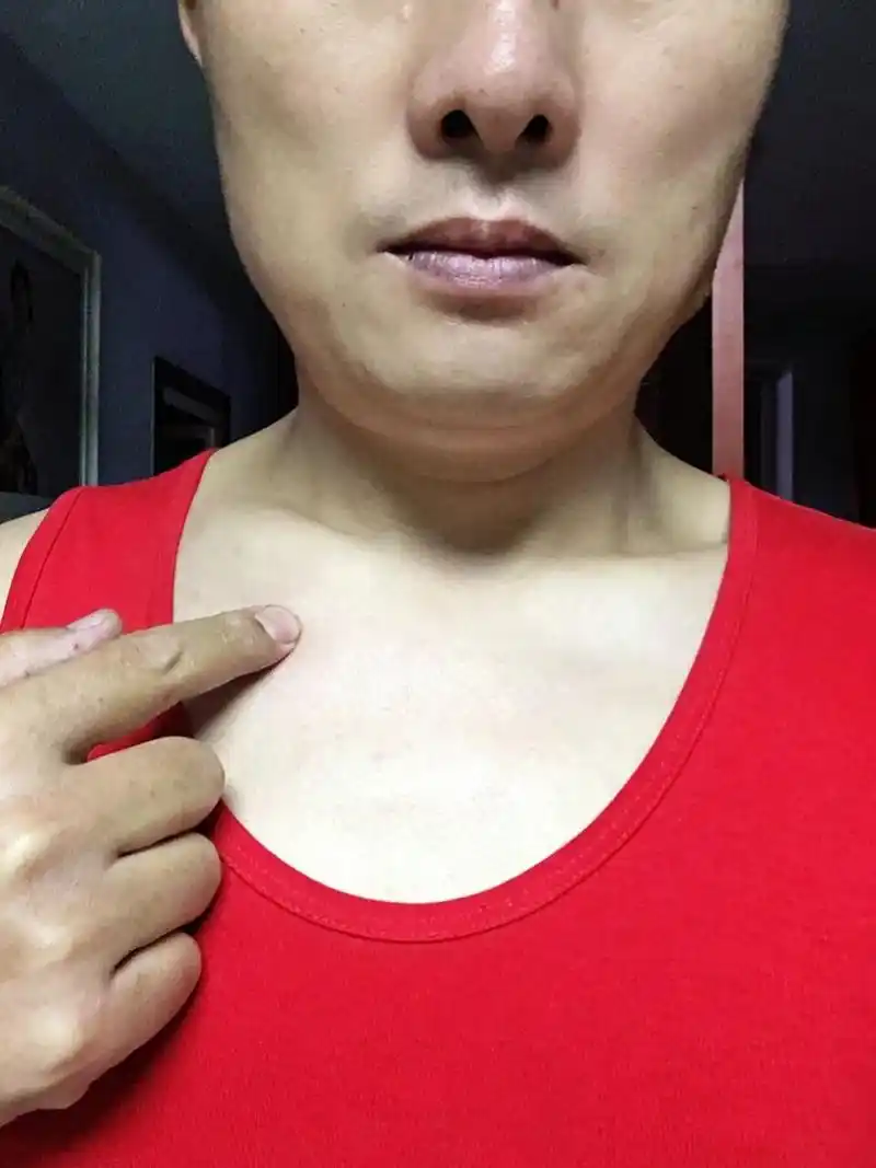 左胸锁骨下有个包,一按很痛,胸口好像有点憋气,有谁知道告诉下