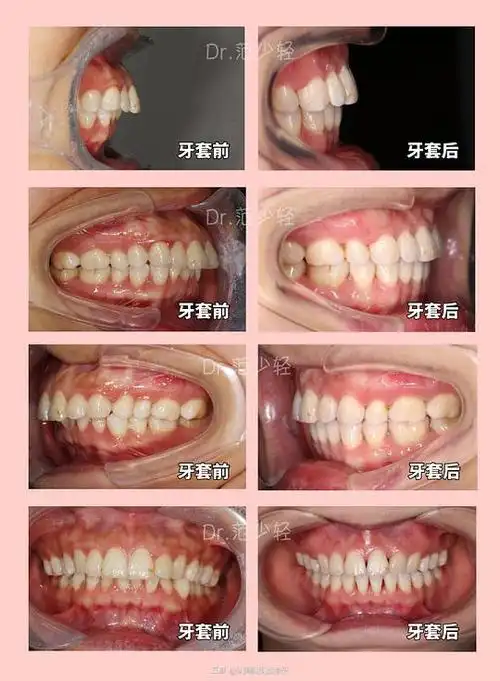 正畸医生范少轻的相册骨性龅牙下颌后缩不想正颌纯正畸改善